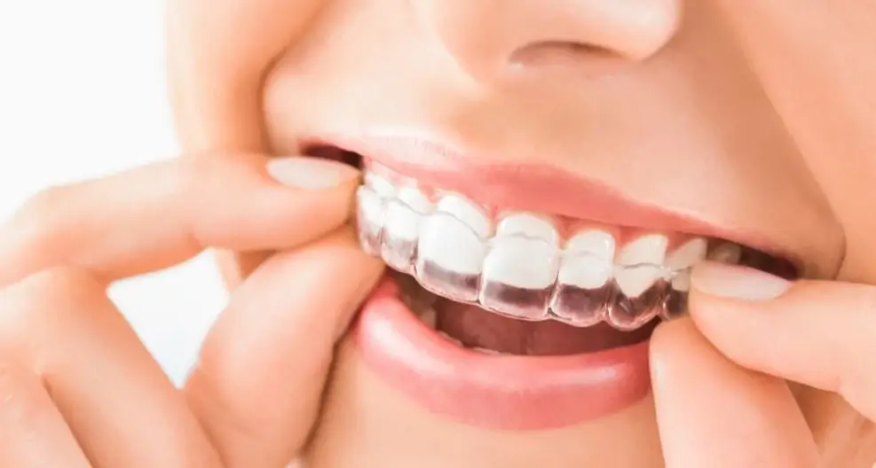 retainers by NYC Dental Lounge