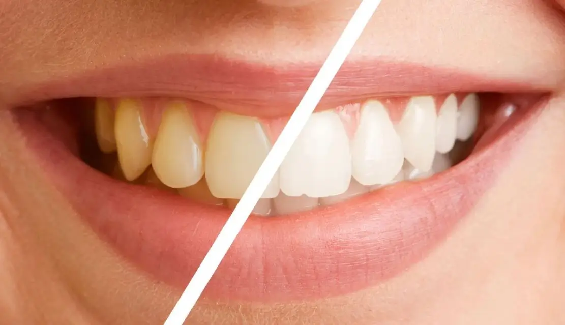 teeth whitening by NYC Dental Lounge