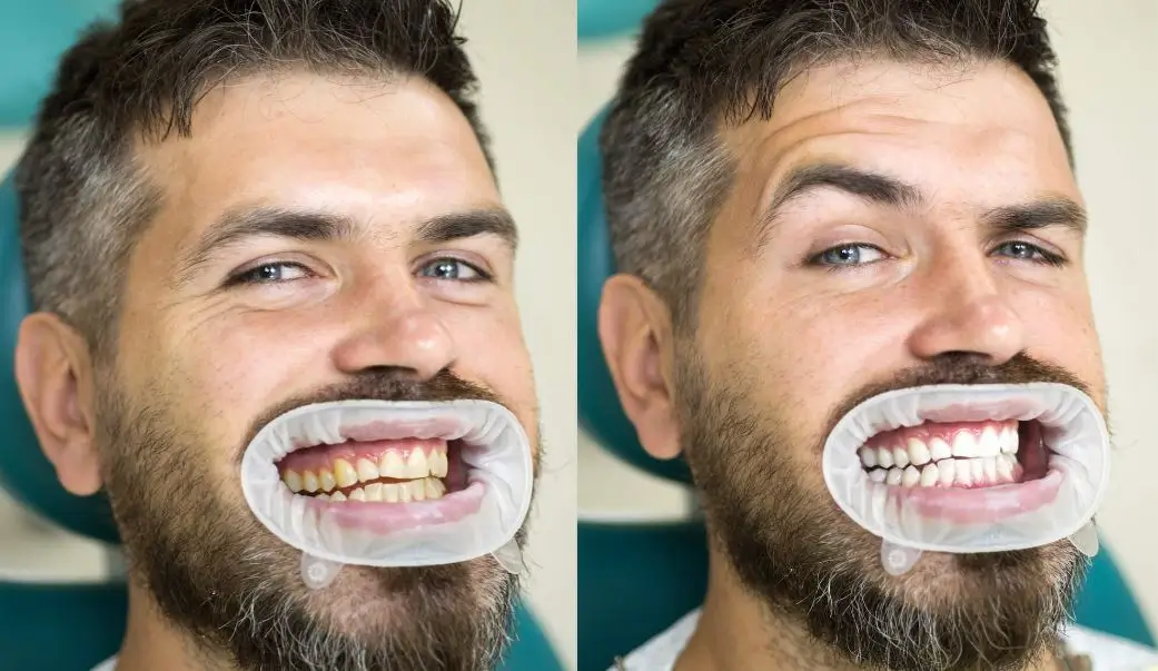 teeth whitening by NYC Dental Lounge